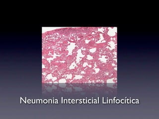 Neumonia Intersticial Linfocítica
 