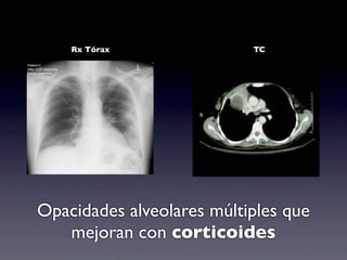 Rx Tórax               TC




Opacidades alveolares múltiples que
   mejoran con corticoides
 