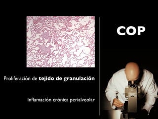COP


Proliferación de tejido de granulación



         Inﬂamación crónica perialveolar
 
