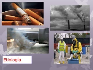 Etiología
 