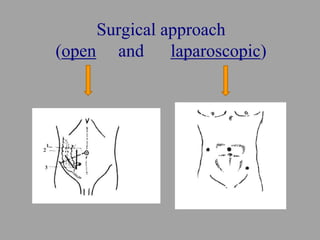 Surgical approach
(open and laparoscopic)
 