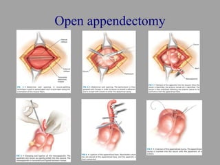 Open appendectomy
 