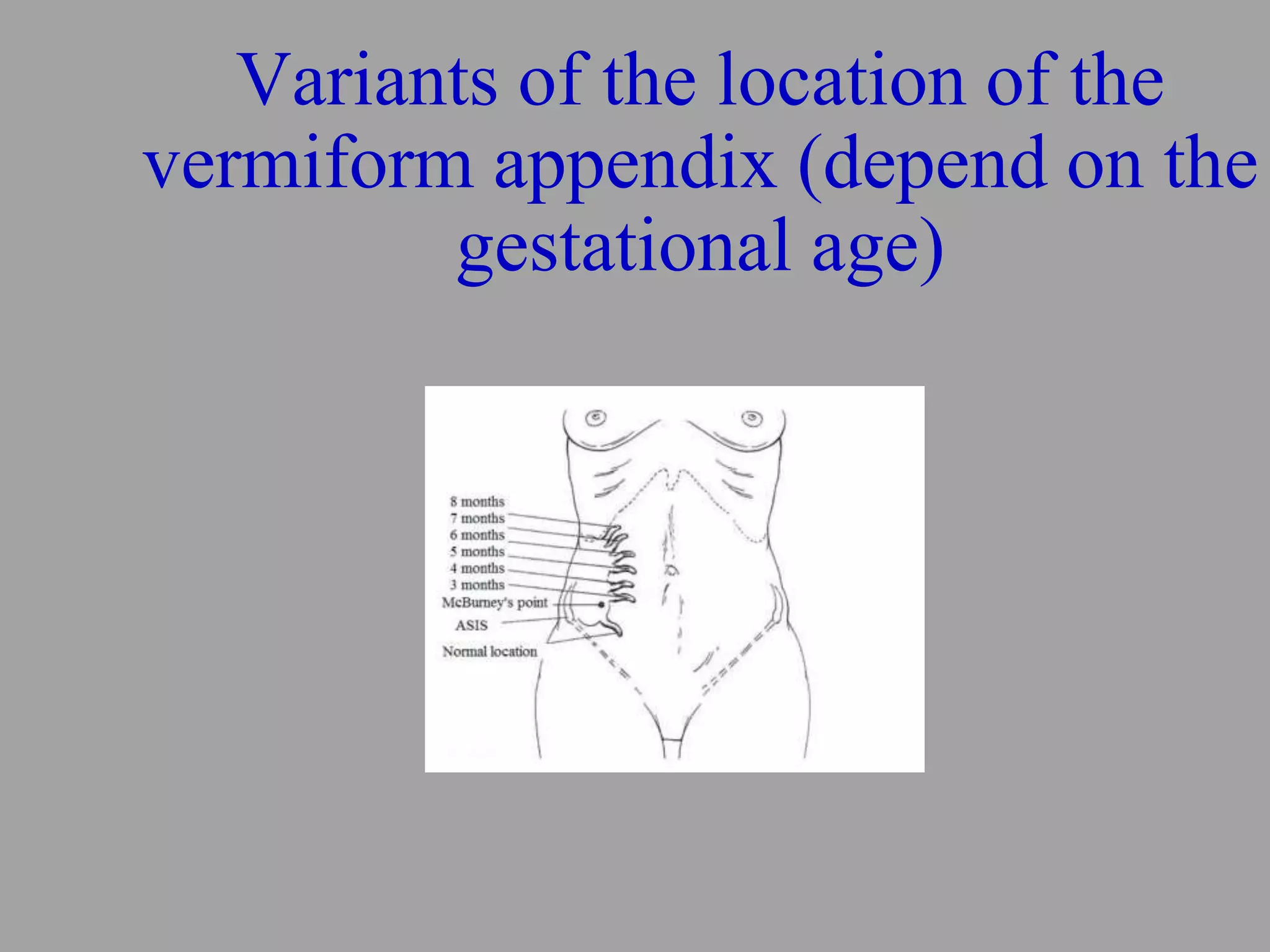 ENGappendicite4.pptx