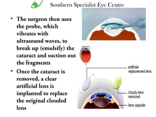 • The surgeon then uses
the probe, which
vibrates with
ultrasound waves, to
break up (emulsify) the
cataract and suction out
the fragments
• Once the cataract is
removed, a clear
artificial lens is
implanted to replace
the original clouded
lens
Southern Specialist Eye Centre
 