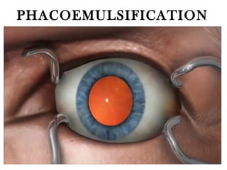 PHACOEMULSIFICATION
 