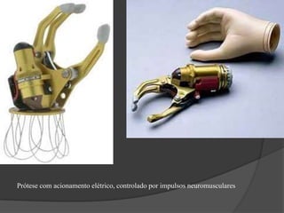 Prótese com acionamento elétrico, controlado por impulsos neuromusculares
 