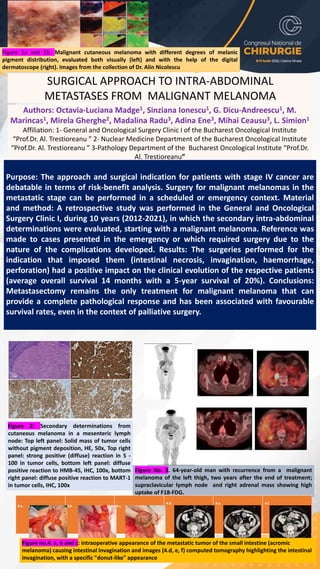 SURGICAL APPROACH TO INTRA-ABDOMINAL
METASTASES FROM MALIGNANT MELANOMA
Authors: Octavia-Luciana Madge1, Sinziana Ionescu1, G. Dicu-Andreescu1, M.
Marincas1, Mirela Gherghe2, Madalina Radu3, Adina Ene3, Mihai Ceausu3, L. Simion1
Affiliation: 1- General and Oncological Surgery Clinic I of the Bucharest Oncological Institute
“Prof.Dr. Al. Trestioreanu ” 2- Nuclear Medicine Department of the Bucharest Oncological Institute
“Prof.Dr. Al. Trestioreanu ” 3-Pathology Department of the Bucharest Oncological Institute “Prof.Dr.
Al. Trestioreanu”
Purpose: The approach and surgical indication for patients with stage IV cancer are
debatable in terms of risk-benefit analysis. Surgery for malignant melanomas in the
metastatic stage can be performed in a scheduled or emergency context. Material
and method: A retrospective study was performed in the General and Oncological
Surgery Clinic I, during 10 years (2012-2021), in which the secondary intra-abdominal
determinations were evaluated, starting with a malignant melanoma. Reference was
made to cases presented in the emergency or which required surgery due to the
nature of the complications developed. Results: The surgeries performed for the
indication that imposed them (intestinal necrosis, invagination, haemorrhage,
perforation) had a positive impact on the clinical evolution of the respective patients
(average overall survival 14 months with a 5-year survival of 20%). Conclusions:
Metastasectomy remains the only treatment for malignant melanoma that can
provide a complete pathological response and has been associated with favourable
survival rates, even in the context of palliative surgery.
Figure 1a and 1b. Malignant cutaneous melanoma with different degrees of melanic
pigment distribution, evaluated both visually (left) and with the help of the digital
dermatoscope (right). Images from the collection of Dr. Alin Nicolescu
Figure 2: Secondary determinations from
cutaneous melanoma in a mesenteric lymph
node: Top left panel: Solid mass of tumor cells
without pigment deposition, HE, 50x, Top right
panel: strong positive (diffuse) reaction in S -
100 in tumor cells, bottom left panel: diffuse
positive reaction to HMB-45, IHC, 100x, bottom
right panel: diffuse positive reaction to MART-1
in tumor cells, IHC, 100x
Figure No. 3. 64-year-old man with recurrence from a malignant
melanoma of the left thigh, two years after the end of treatment;
supraclavicular lymph node and right adrenal mass showing high
uptake of F18-FDG.
4.a. 4.b. 4.c.
4.d. 4.e. 4.f.
Figure no.4. a, b and c: intraoperative appearance of the metastatic tumor of the small intestine (acromic
melanoma) causing intestinal invagination and images (4.d, e, f) computed tomography highlighting the intestinal
invagination, with a specific "donut-like" appearance
 