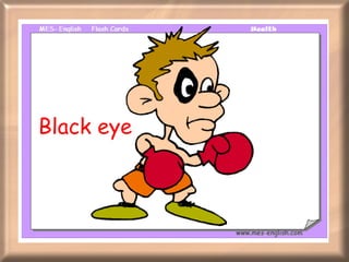 Black eye 