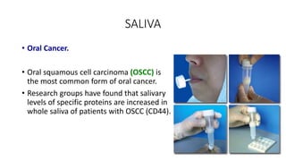 SALIVA
• Oral Cancer.
• Oral squamous cell carcinoma (OSCC) is
the most common form of oral cancer.
• Research groups have found that salivary
levels of specific proteins are increased in
whole saliva of patients with OSCC (CD44).
 