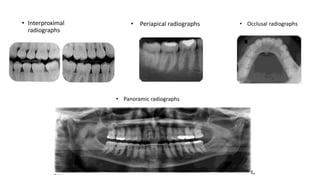 • Interproximal
radiographs
• Periapical radiographs • Occlusal radiographs
• Panoramic radiographs
 