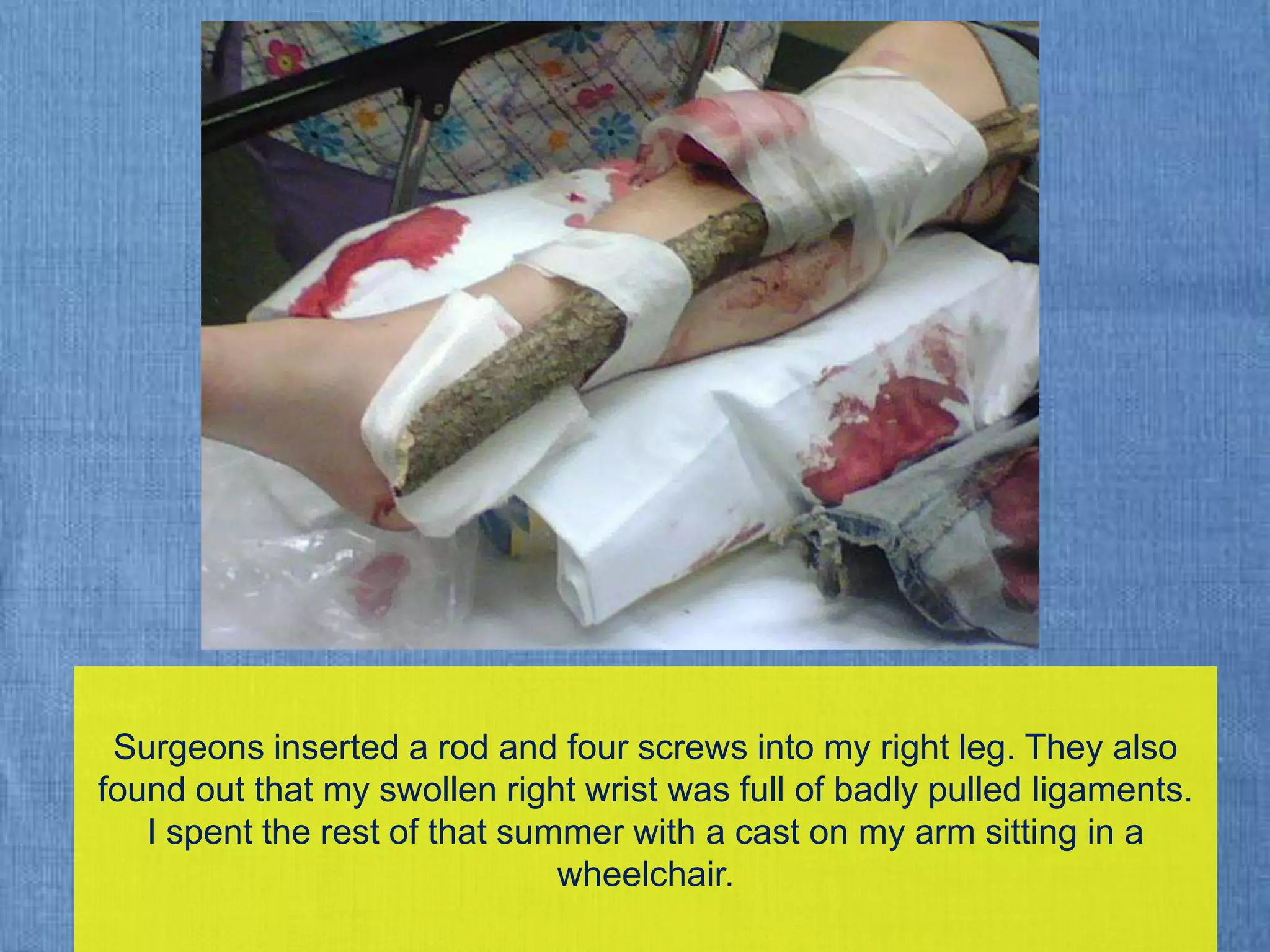 Surgeons inserted a rod and four screws into my right leg. They also found out that my swollen right wrist was full of badly pulled ligaments.  I spent the rest of that summer with a cast on my arm sitting in a wheelchair.