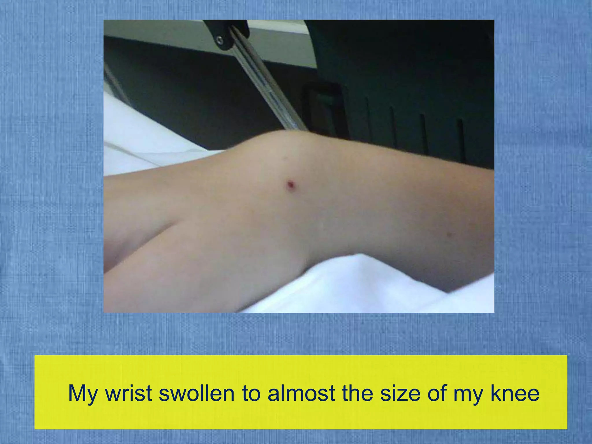  My wrist swollen to almost the size of my knee