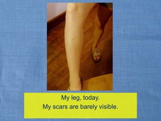 ssdMy leg, today. My scars are barely visible.