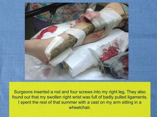 Surgeons inserted a rod and four screws into my right leg. They also found out that my swollen right wrist was full of badly pulled ligaments.  I spent the rest of that summer with a cast on my arm sitting in a wheelchair.