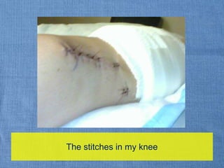 The stitches in my knee
