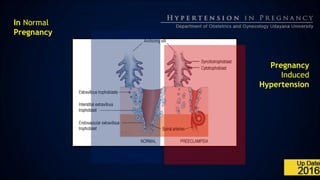 In Normal
Pregnancy
Pregnancy
Induced
Hypertension
 