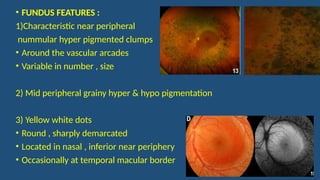 Enhanced s cone syndrome . features , pathophysiology | PPTX