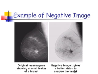 Example of Negative Image




  Original mammogram      Negative Image : gives
 showing a small lesion      a better vision to
       of a breast          analyze the image14
 