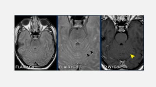 Cns Pattern ENHANCMENT PATTERNS IN CNS................pptx