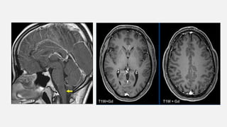 Cns Pattern ENHANCMENT PATTERNS IN CNS................pptx