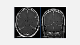 Cns Pattern ENHANCMENT PATTERNS IN CNS................pptx