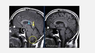 Cns Pattern ENHANCMENT PATTERNS IN CNS................pptx