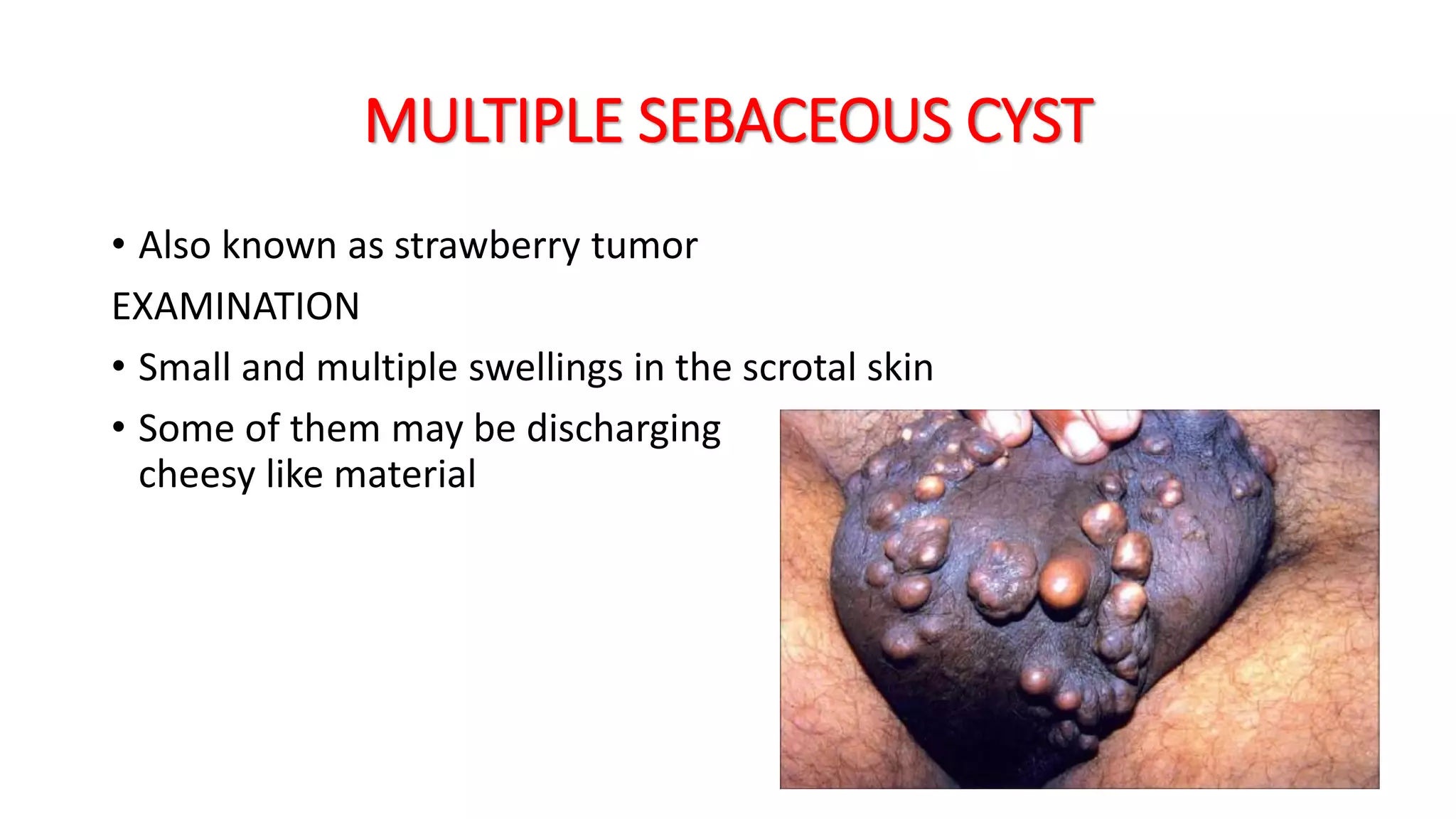 DIFFERENTIAL DIAGNOSIS OF INGUINOSCROTAL SWELLING | PPTX
