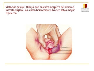 Violación sexual: Dibujo que muestra desgarro de hímen e
introito vaginal, así como hematoma vulvar en labio mayor
izquierdo

 