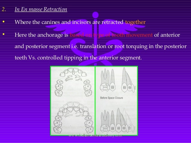 The Maxillary En Masse Retraction In The Miniscrew Group A The Download Scientific Diagram