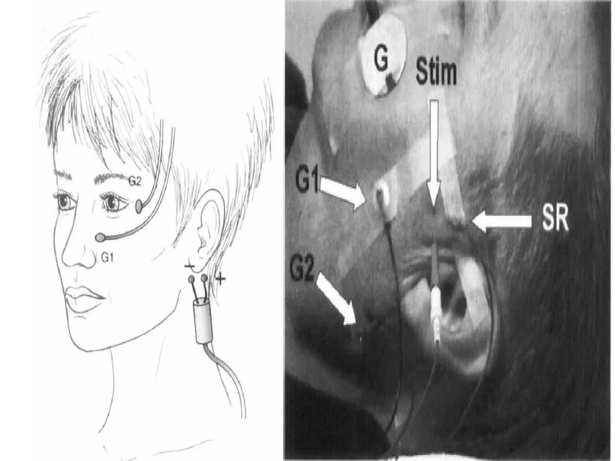 Rns Test repetitive nerve stimulation | PPT