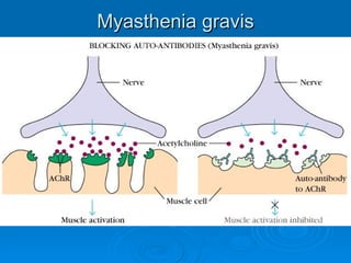 Repetitive Nerve Stimulation PPT