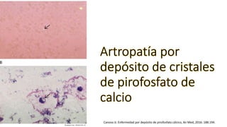 Canoso JJ. Enfermedad por depósito de pirofosfato cálcico, An Med, 2016: 188.194.
 