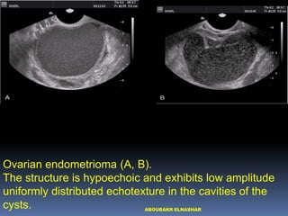 Management of Endometrioma associated infertility | PDF