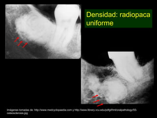 Densidad: radiopaca
                                                                 uniforme




Imágenes tomadas de: http://www.medcyclopaedia.com y http://www.library.vcu.edu/pdfgif/tml/oralpathology/55-
osteosclerosis.jpg
 