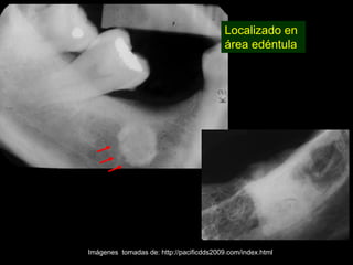 Localizado en
                                          área edéntula




Imágenes tomadas de: http://pacificdds2009.com/index.html
 