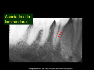 Asociado a la
lamina dura.




            Imagen tomada de: http://student.ahc.umn.edu/dental/
 