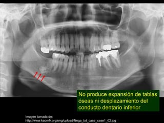 No produce expansión de tablas
                                 óseas ni desplazamiento del
                                 conducto dentario inferior
Imagen tomada de:
http://www.kaomfr.org/eng/upload/Nega_bd_case_case1_62.jpg
 