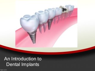 An Introduction to
Dental Implants

 