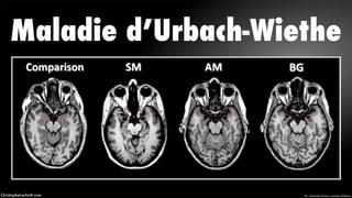 Pic - University of Iowa, courtesy of NatureChristopheLachnitt.com
Maladie d’Urbach-Wiethe
 