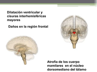 Dilatación ventricular y
cisuras interhemisféricas
mayores
Daños en la región frontal

Atrofia de los cuerpo
mamilares en el núcleo
dorsomediano del tálamo

 