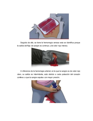 Seguido de ello, se tiene la hemorragia venosa esta se identifica porque
la salida del flujo de sangre es continua y de color rojo intenso.
A diferencia de la hemorragia arterial, en la que la sangre es de color rojo
claro, su salida es intermitente, esto debido a cada pulsación del corazón
conlleva a que la sangre expulsa con mayor presión.
 