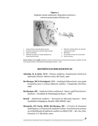Figura 1:
                  Implante coclear multicanal. Dispositivos internos e
                         externos posicionados (Nucleus 24).




1.	   Antena interna colocada abaixo da pele	       5.	             Eletrodo colocado abaixo do músculo
2.	   Receptor transmissor colocado abaixo da pele		                temporal (ground)
3.	   Cabo de eletrodos	                            6.	             Microfone
4.	   Eletrodos inseridos na rampa timpânica da 	   7.	             Processador de fala retro-auricualar
	     espira basal da cóclea	                       8.	             Antena externa

Fonte: Costa, A. O. (1998). Implantes cocleares multicanais no tratamento da surdez em adultos. Tese de
Livre-docência Bauru: Faculdade de Odontologia de Bauru – USP.




                       Referências Bibliográficas

Almeida, K.  Iório, MCM - Próteses Auditivas: Fundamentos Teóricos 
   Aplicações Clínicas. Editora Lovise, São Paulo, 1996.

Bevilacqua, MC  Formigoni, GMP – Audiologia Educacional: uma opção
    terapêutica para a criança deficiente auditiva - Carapicuiba, Pró-Fono,
    1996.

Bevilacqua, MC – Implante Coclear multicanal – Bauru, 1998 [Tese de Livre-
    Docência – Faculdade de Odontologia de Bauru – USP].

Brasil – Deficiência auditiva – Secretaria de Educação Especial – Série
    Atualidades Pedagógicas, Brasília: MEC/SEESP, 1997.

Mesquita, ST; Faria, MEB; Bevilacqua, MC – O Centro de Pesquisas
   Audiológicas e o Programa de Implante Coclear: uma história de avanços
   na (re)habilitação do deficiente auditivo no HRAC/USP. – Rev. Soc. Bras.
   Fonoaud. n° 6. São Paulo, 2000.

			                                                                                                     29
DESENVOLVENDO COMPETÊNCIAS PARA O ATENDIMENTO ÀS NECESSIDADES EDUCACIONAIS ESPECIAIS DE ALUNOS SURDOS
 