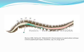Morrison LMM, McClure JH, Wildsmith JAW. Clinical evaluation of a spinal catheter technique
in femoro-popliteal graft surgery, Anaesthesia , 1991, vol. 46 (pg. 576-8)
 