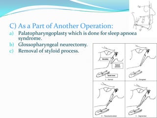 C) As a Part of Another Operation:
a) Palatopharyngoplasty which is done for sleep apnoea
   syndrome.
b) Glossopharyngeal neurectomy.
c) Removal of styloid process.
 
