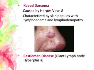 • Kaposi Sarcoma
Caused by Herpes Virus 8
Characterized by skin papules with
lymphoedema and lymphadenopathy
• Castleman Disease (Giant Lymph node
Hyperplasia)
11
 