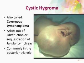 Cystic Hygroma
• Also called
Cavernous
Lymphangioma
• Arises out of
Obstruction or
sequestration of
Jugular Lymph sac
• Commonly in the
posterior triangle
12
 