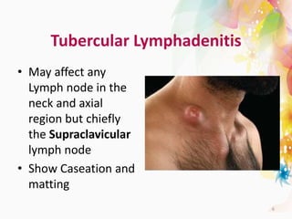 Tubercular Lymphadenitis
• May affect any
Lymph node in the
neck and axial
region but chiefly
the Supraclavicular
lymph node
• Show Caseation and
matting
6
 