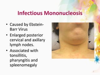 Infectious Mononucleosis
• Caused by Ebstein-
Barr Virus
• Enlarged posterior
cervical and axillary
lymph nodes.
• Associated with
tonsillitis,
pharyngitis and
spleenomegaly
7
 
