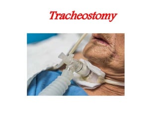 Tracheostomy
 
