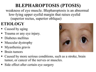 BLEPHAROPTOSIS (PTOSIS)
weakness of eye muscle. Blepharoptosis is an abnormal
low-lying upper eyelid margin that raises eyelid
(superior rectus, superior oblique)
ETIOLOGY
 Caused by aging
 Trauma or any eye injury.
 Diabetes mellitus
 Muscular dystrophy
 Myasthenia gravis
 Brain tumors
 Caused by more serious conditions, such as a stroke, brain
tumor, or cancer of the nerves or muscles.
 Side effect after certain eye surgery
 